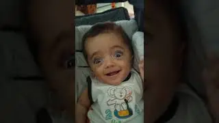Osteog&ecirc;nese imperfeita Tipo II