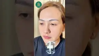 Cấy HA &ndash; Collagen Trẻ H&oacute;a V&ugrave;ng Mắt | Thẩm Mỹ Viện Hoa Anh #thammyvienhoaanh