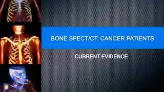02 Bone SPECT CT in patients with cancer