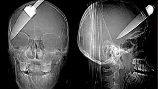 Top 15 Strangest Things Found in an X-Ray