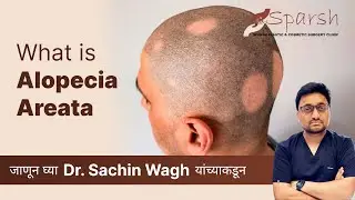 Hair Falling in patches? Alopecia Areata might be the reason 