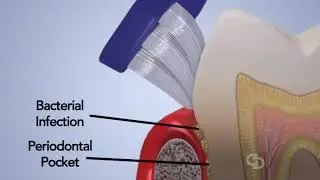 Perio Protect trays Video