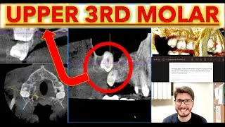SURGICAL Planning of Impacted Maxillary Third Molars: CBCT technique, Upper 3rd molar surgery, sinus