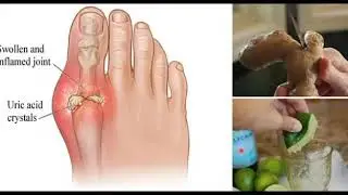 How To Prevent Gout Naturally At Home_How To Prevent  Gout Attacks Naturally Without Medicines|Gout