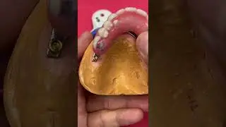 Locator Hybrid Bar for an Overdenture case