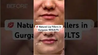 💋 Natural Lip Fillers in Gurgaon | Subtle Enhancement by Dr. Ritesh Anand