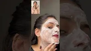 Acne/Pimple (oily skin) Remedy by Dr.Upasana Vohra✨🫶🏻 #trendingreels#homemade #oilyskin#pimples#