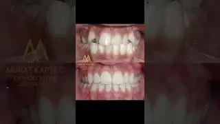 MK ŞEFFAF PLAKLAR ile tedavi &ouml;ncesi ve sonrası! 🇺🇸 Before and after treatment with MK ALIGNERS!