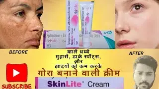 SkinLite Cream Review And  Uses | How SkinLite Cream Works |  SkinLite  क्रीम कैसे काम करता हैं ।