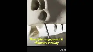 Animated video of nasal floor engagement and guided nerve bypass.