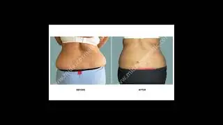 Best Liposuction Treatment in Bangalore | Before & After Results | Midas Cosmetic Surgery Clinic
