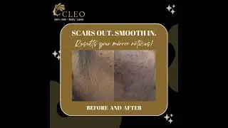Acne Scar Treatment Results | Real Skin Transformation at Cleo
