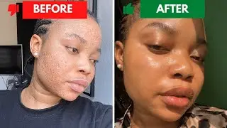 How To Get CLEAR SKIN IN ONE WEEK IN 2025 !!