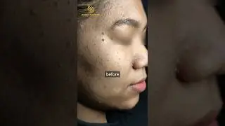 Skin Tags 1 tahun Setelah Laser CO2, Tumbuh Lagi? #Skintags #LaserCO2 #ShineryAesthetic