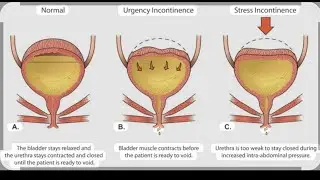 CLASS 45: STRESS INCONTINENCE, URGE INCONTINENCE