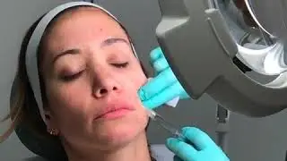 JUVEDERM VOLUMA