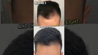 This Guy Had Massive Hair Shedding After Regrowth!