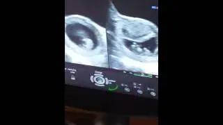 Twin ultrasound shocked! Surprise