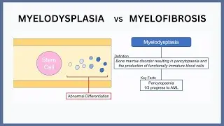 Myelodysplasia vs Myelofibrosis Explained