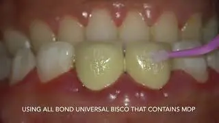 orthodontic brackets bonding to porcelain crowns by dr Amr Asker