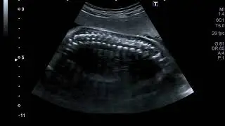 adenomatoza pulmonara