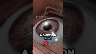 Clearer vision with LASIK (3D Animation)