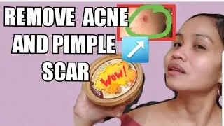 HOW TO  REMOVE ACNE SCARS AND DARK SPOTS BY USING RAW SHEA BUTTER
