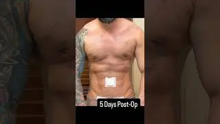 Pre-Op/5 Days Post-Op #bodytransformation #beforeandafter #gynecomastiaresult #bodysculpting #male