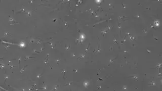 Oligozoospermia media (Spermiogramma) - Centro Raprui