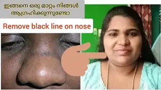 Remove black line on nose | Black line in the nose &Pigmentation / How to hide pigmentation on nose