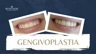 Gengivoplastia ou Cirurgia plástica gengival: Tudo o que você precisa saber! | Dra Andressa Mezzomo