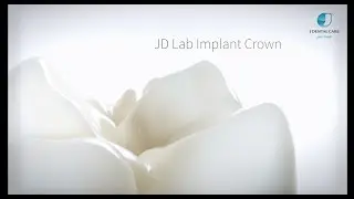 JDlab Implant Crown: estetica e resistenza