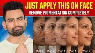 Get Rid of Skin Pigmentation in 4 Steps (No More Dark Spots/ Acne Marks)