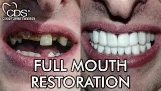Impressive Full Mouth Restoration in Mexico: Justin's Review | Cancun Dental Specialists