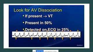 ECG in arrhythmias -Lecture 1