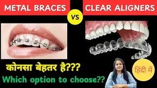Invisible Braces बेहतर  या Regular Braces? Braces cost?? Cost of Aligners.