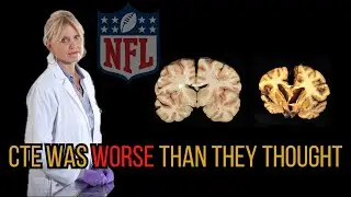 The NFL's Worst Nightmare: The Brain Bank Exposes CTE