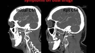 Bilateral Cervical ICA Dissections: stenting
