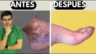 &iquest;tienes mas de 50 a&ntilde;os? activa tu bombeo vascular