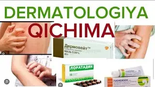 QICHIMA KASALLIGI SABABI , KLINIKASI , TOSHMA QANDAY VA DAVOLASH #dermatology #khan #retseptlar