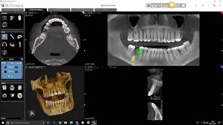 CS 3D Imaging - Implants nouvelle version 1.18