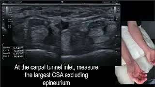 Median Nerve WFR Carpal Tunnel Ultrasound Hobson-Webb