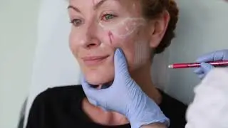Juvederm Mid-Face Contouring: Unlock Facial Danger Zone Secrets & Wow Results! 😍