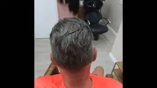 man hair system before and after in Malaga.