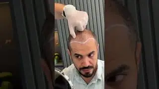 Hair Transplant in Turkey | Hair Transplant 5000 grafts #hairtransplantturkey