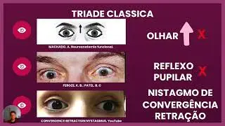 S&iacute;ndrome de parinaud - correla&ccedil;&otilde;es anatomoclinicas - Neuroanatomia Funcional (Machado, A. 4a ed)