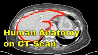 Part 3:  Easily Learn Human Anatomy on CT Scan