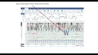 Sleep Study Graph: The various sections of a Polysomnograph for Beginners