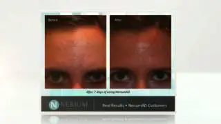 Non Surgical Facelift | NeriumAD | Before and After Views