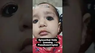 Epicanthal folds ( causing Pseudoesotropia)